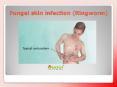 Fungal skin infection (Ringworm): Causes, Symptoms, Risk Factor, Diagnosis and Treatment PowerPoint PPT Presentation