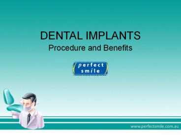 Dental Implants - Procedure and Benefits