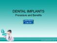 Dental Implants - Procedure and Benefits PowerPoint PPT Presentation