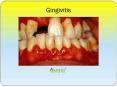 Gingivitis: Symptoms, Causes, Diagnosis and Treatment PowerPoint PPT Presentation