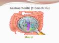 Gastroenteritis (Stomach Flu): Symptoms, causes, diagnosis and treatment PowerPoint PPT Presentation