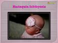 Harlequin Ichthyosis: Causes, symptoms, diagnosis and treatment PowerPoint PPT Presentation