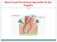 Root Canal Treatment Specialist In los Angeles