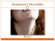Hashimoto's thyroiditis: The most common form of thyroiditis