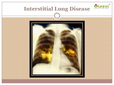 Interstitial Lung Disease: Causes, symptoms, diagnosis and treatment