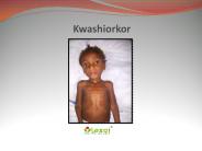 Kwashiorkor: A Protein Deficiency Disorder
