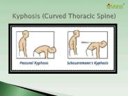 Kyphosis (Curved Thoracic Spine): Symptoms, types, causes and treatment