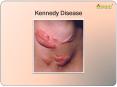 Kennedy disease: A study of symptoms, causes, diagnosis and treatment PowerPoint PPT Presentation