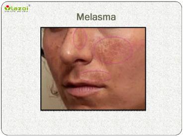 Melasma: Symptoms, causes and treatment