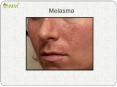 Melasma: Symptoms, causes and treatment PowerPoint PPT Presentation