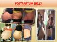 Postpartum Belly PowerPoint PPT Presentation