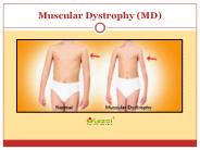 Muscular dystrophy: Causes, symptoms, diagnosis and treatment