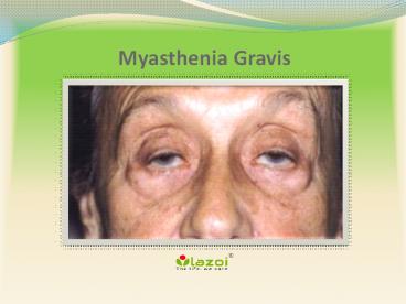 Myasthenia Gravis: Symptoms, Causes, diagnosis and treatment