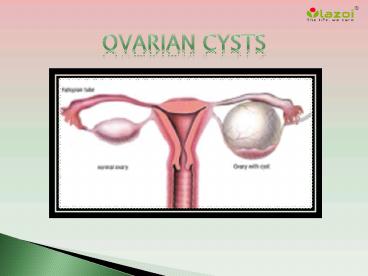 Ovarian Cysts: Common Uterine Conditions