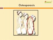 An overview of osteoporosis