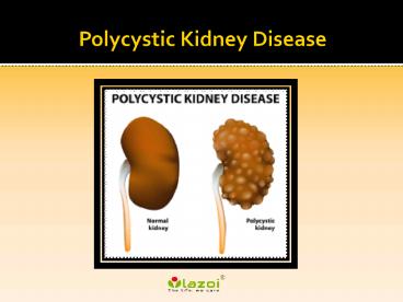Polycystic kidney disease : Causes, Symptoms, Diagnosis, Complication and Treatment
