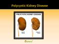 Polycystic kidney disease : Causes, Symptoms, Diagnosis, Complication and Treatment PowerPoint PPT Presentation