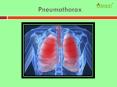 Pneumothorax: Symptoms, causes, diagnoses and treatment PowerPoint PPT Presentation