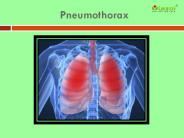 Pneumothorax: Symptoms, causes, diagnoses and treatment