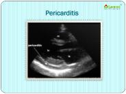 Pericarditis: causes, symptoms and treatment
