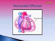 Pericardial Effusion - Heart disease