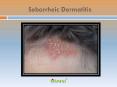 Seborrheic Dermatitis: Symptoms, causes and treatment PowerPoint PPT Presentation