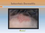 Seborrheic Dermatitis: Symptoms, causes and treatment