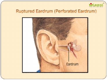 Ruptured Eardrum (Perforated Eardrum): A sneak peek