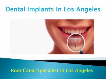 Best dental implants in los angeles