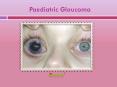 Why parents need to know extensively about childhood glaucoma PowerPoint PPT Presentation