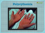 Polycythemia: Causes, Symptoms and Treatment