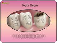 Tooth Decay: Symptoms, causes and treatment