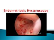 Endometriosis Hysteroscopy 16 sep  17