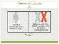 Turner syndrome: Symptoms, Causes, Treatment of Turner syndrome PowerPoint PPT Presentation