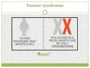 Turner syndrome: Symptoms, Causes, Treatment of Turner syndrome