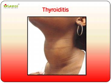 Thyroiditis: A clinical in-sight
