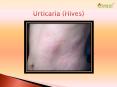 Urticaria (Hives): Symptoms, Causes, Diagnosis and Treatment PowerPoint PPT Presentation