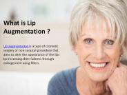 The Lip Augmentation Procedure