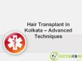 Hair Transplant in Kolkata - Advanced Techniques PowerPoint PPT Presentation