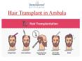 Hair Transplant in Ambala