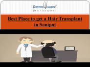 Hair Transplantation in Sonipat
