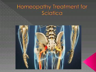 Homeopathy Treatment for Sciatica 10 oct 17