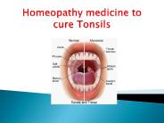 Homeopathy medicine to cure Tonsils (1)