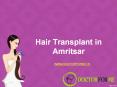 Hair Transplant in Amritsar