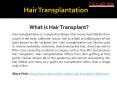 About Hair Transplantation PowerPoint PPT Presentation
