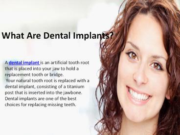 What Are Dental Implants?
