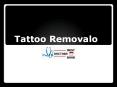 tatto removal PowerPoint PPT Presentation