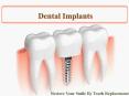 A Complete Guide to Dental Implants Treatment