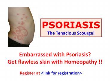 Psoriasis (1)