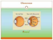 An overview of Glaucoma symptoms, causes and treatment